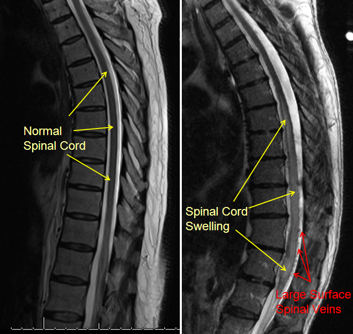 Spinal Cord Dural Arteriorvenous Fistulas The Neurosurgical Atlas