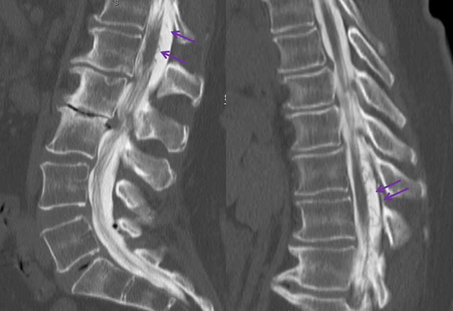 Spinal Dural Fistula CT Myelogram