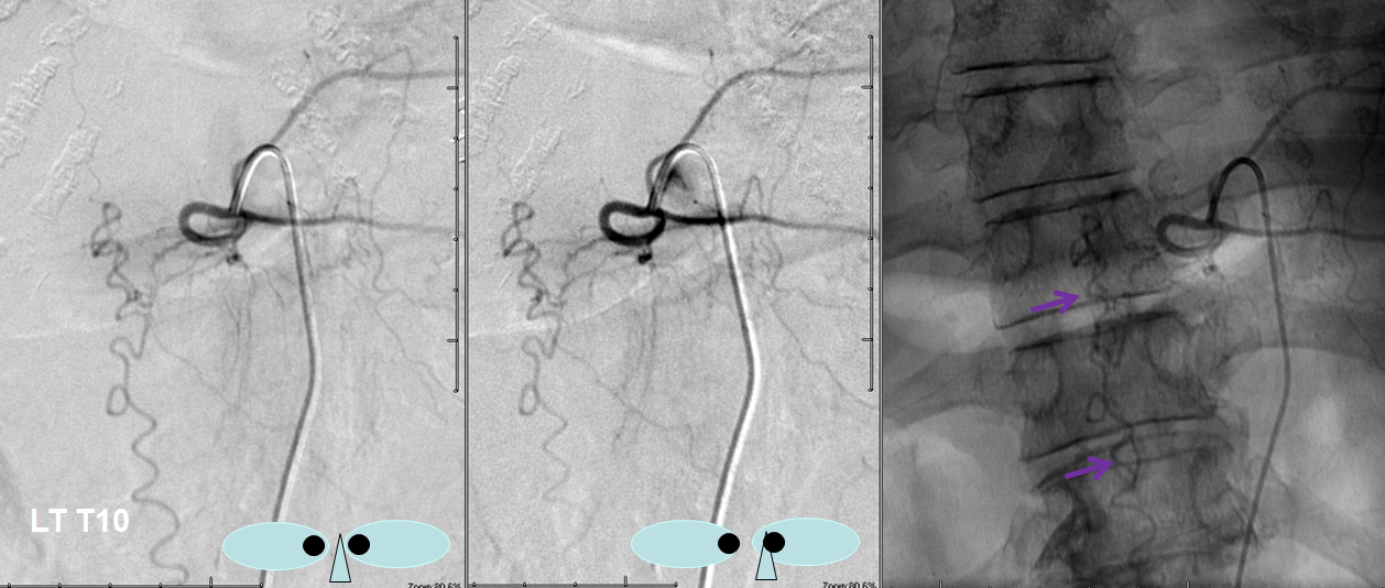 Spinal Dural Fistula angio stereo