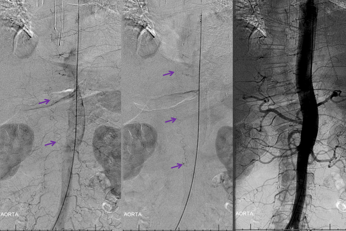 Spinal dural fistula aortogram