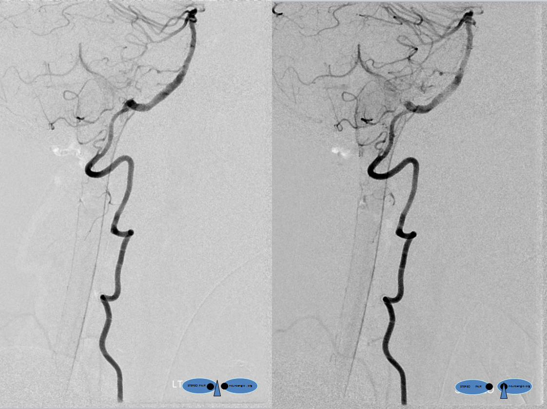 ASA from distal vert