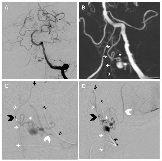 PICA reconstitution by the anterior spinal artery