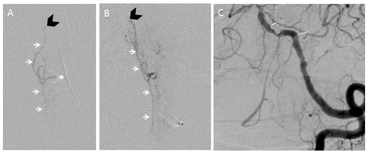 anterior spinal artery reconstitution of the PICA