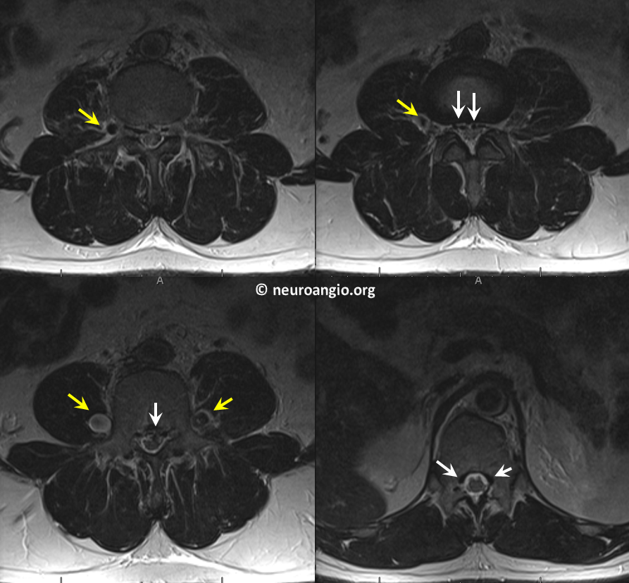 Batson's Plexus MRI