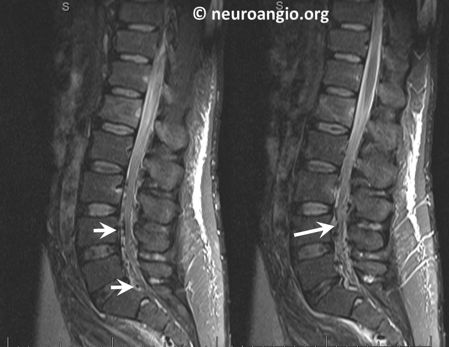 Batson's Plexus MRI