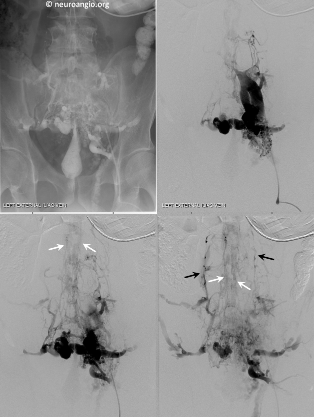 Batson's Plexus Venogram