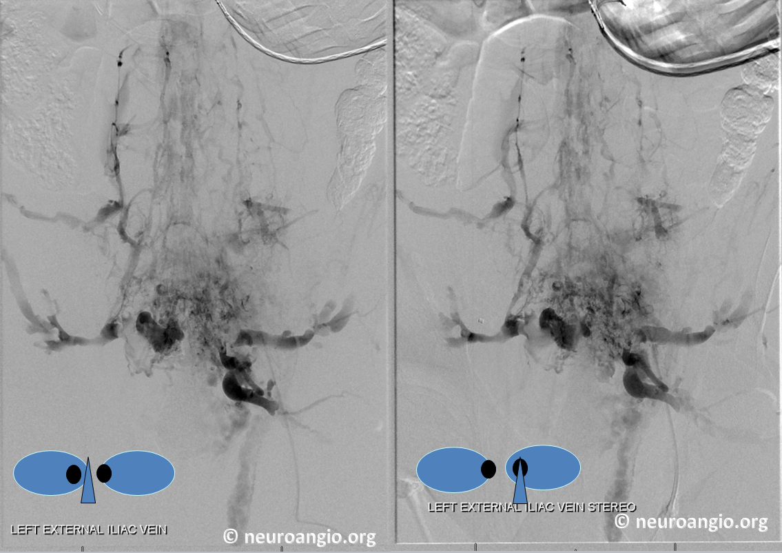 Batson's Plexus Venogram