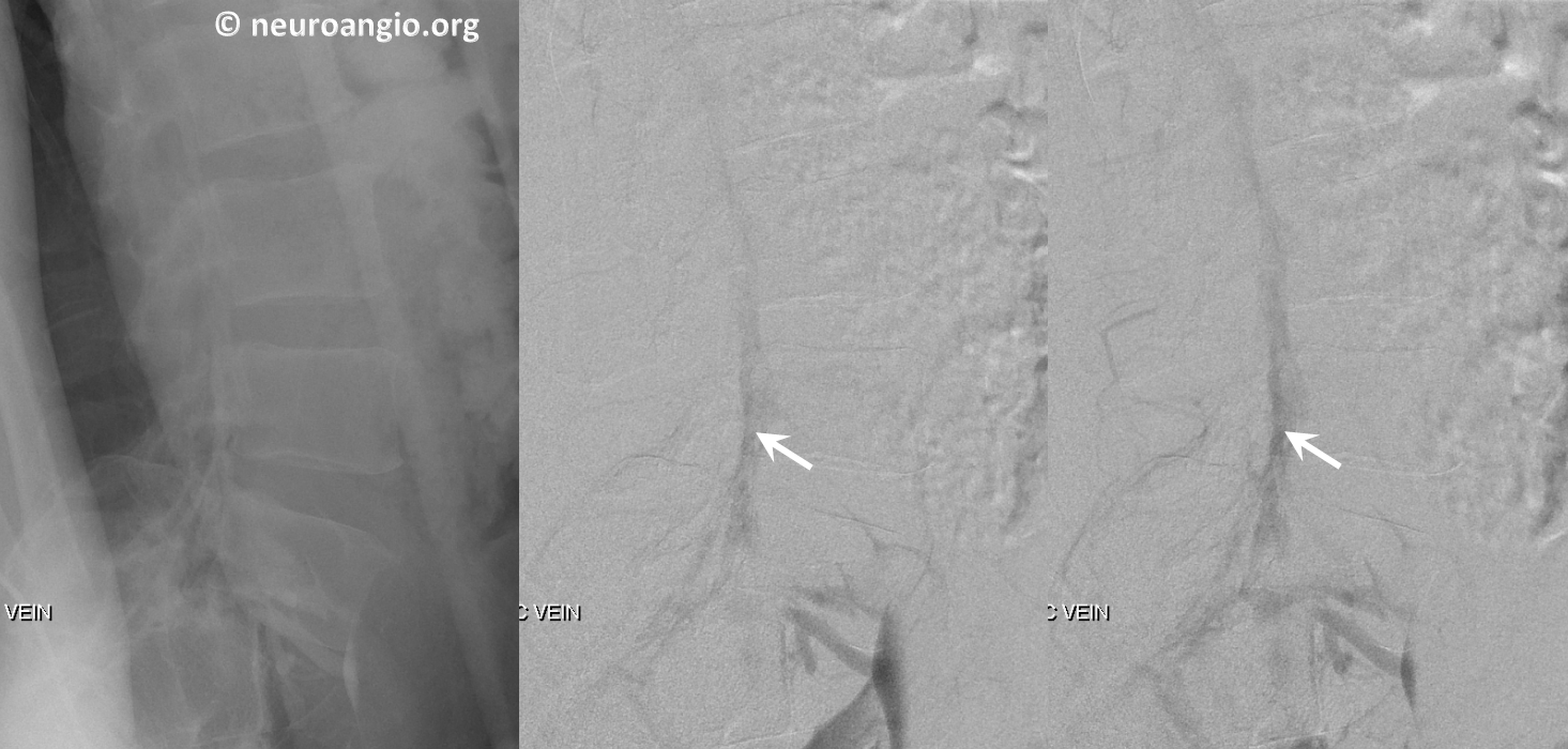 Batson's Plexus Venogram