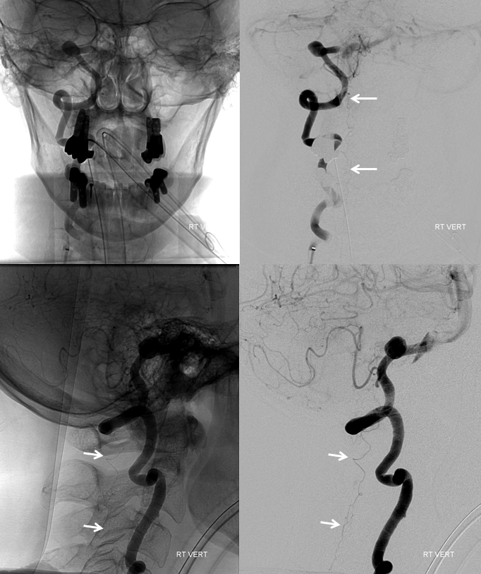 Lateral Spinal Artery