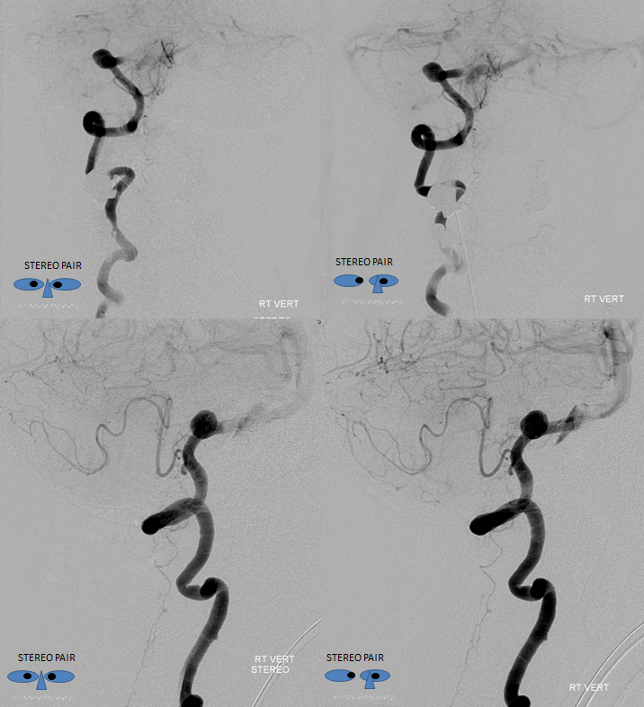 Lateral Spinal Artery Stereo