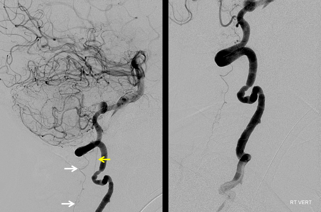 Lateral and Anterior Spinal Arteries