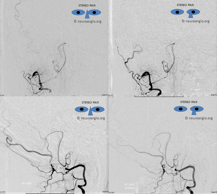 Lateral Spinal Artery