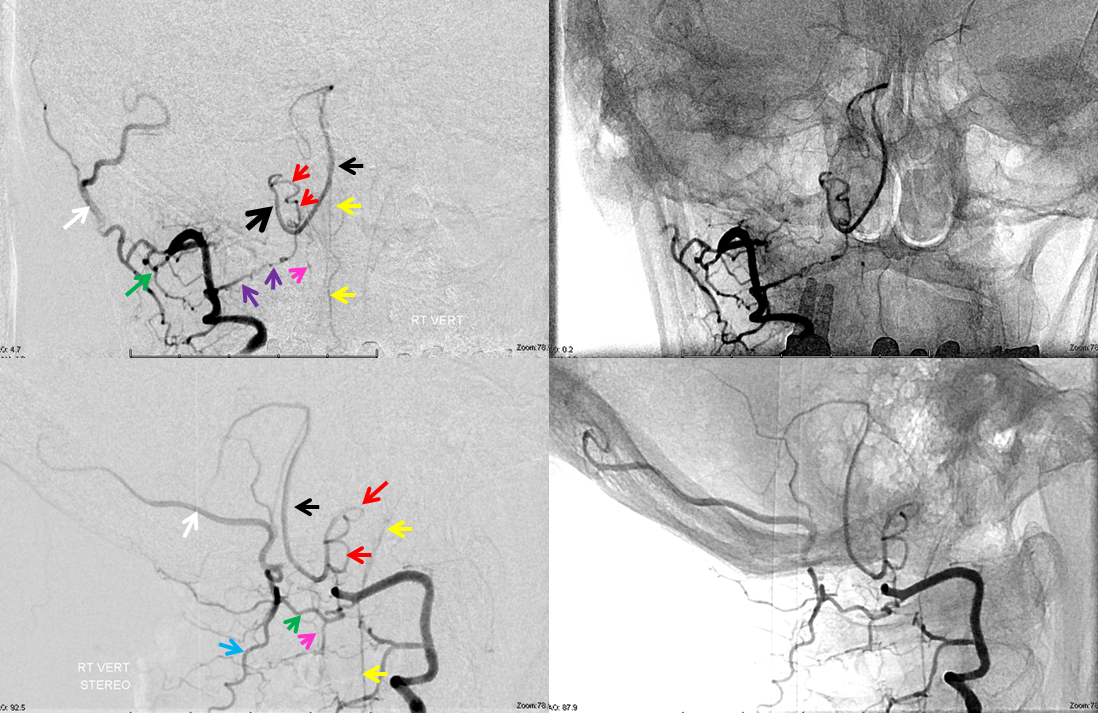 Lateral Spinal Artery