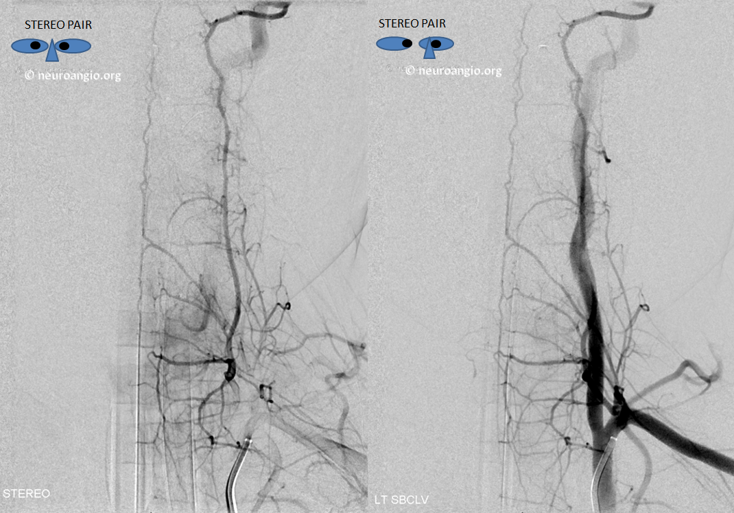 duplicated anterior spinal artery