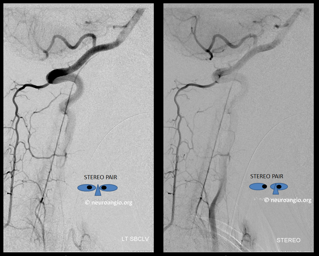 duplicated anterior spinal artery