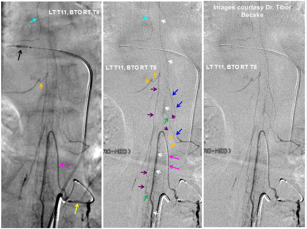 http://www.neuroangio.org/wp-content/uploads/Spinal/Spinal_spinal_axis_BTO_2.png