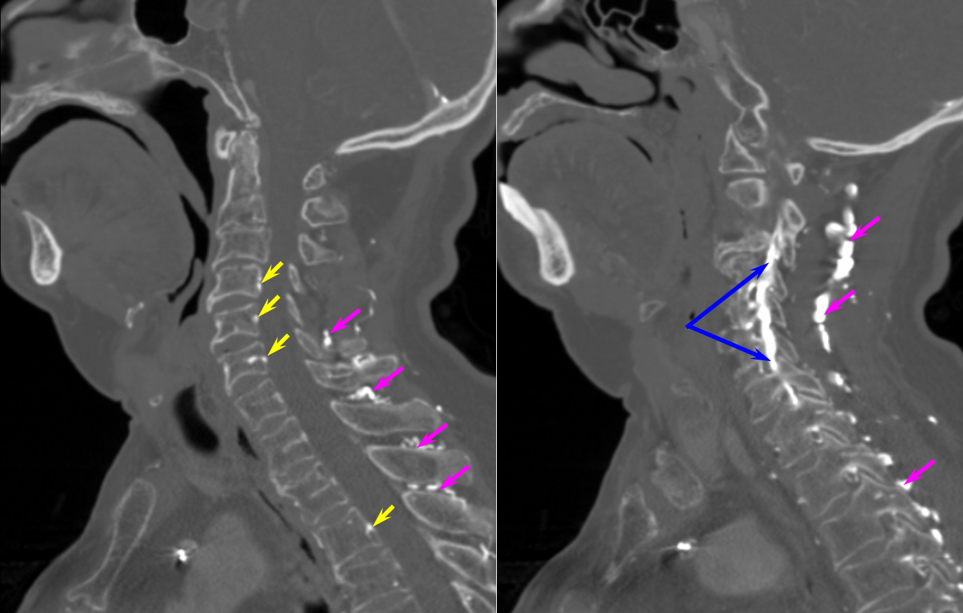 Spinal Vascular Anatomy Neuroangio Org