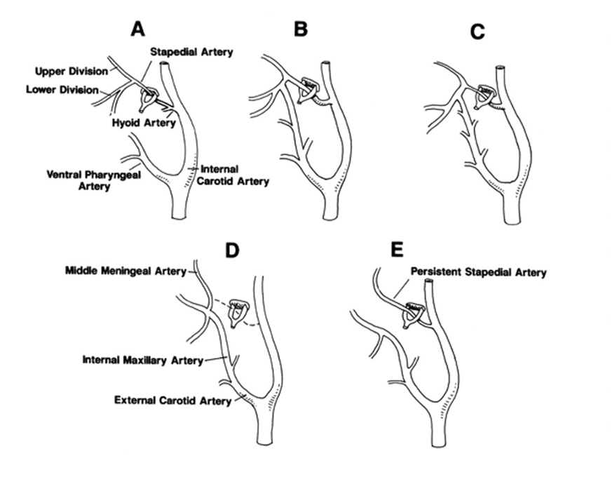 http://www.neuroangio.org/wp-content/uploads/Stapedial_Artery/Stapedial_Artery_1.png