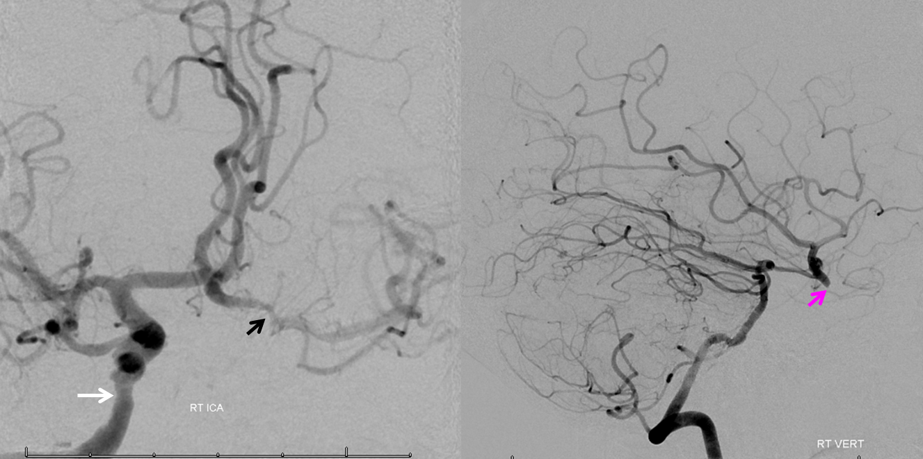 http://www.neuroangio.org/wp-content/uploads/Stapedial_Artery/Stapedial_Artery_14.png