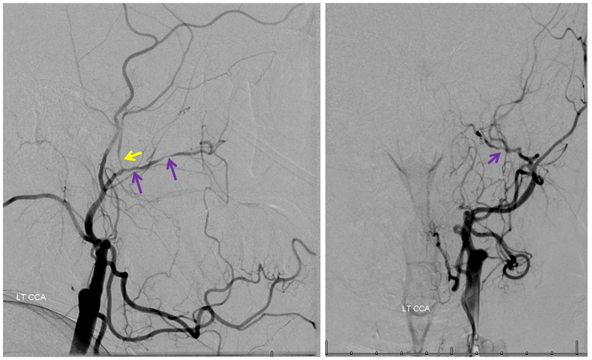 http://www.neuroangio.org/wp-content/uploads/Stapedial_Artery/Stapedial_Artery_15.png