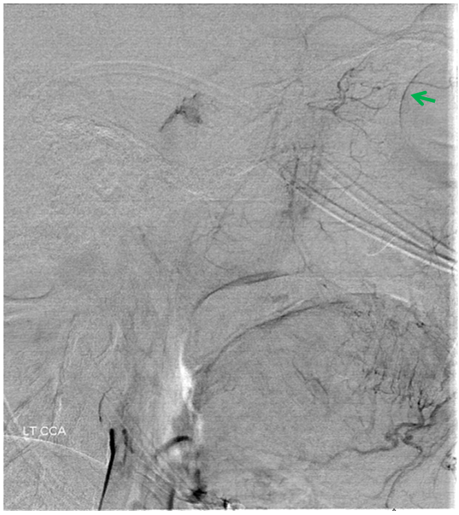 http://www.neuroangio.org/wp-content/uploads/Stapedial_Artery/Stapedial_Artery_16.png