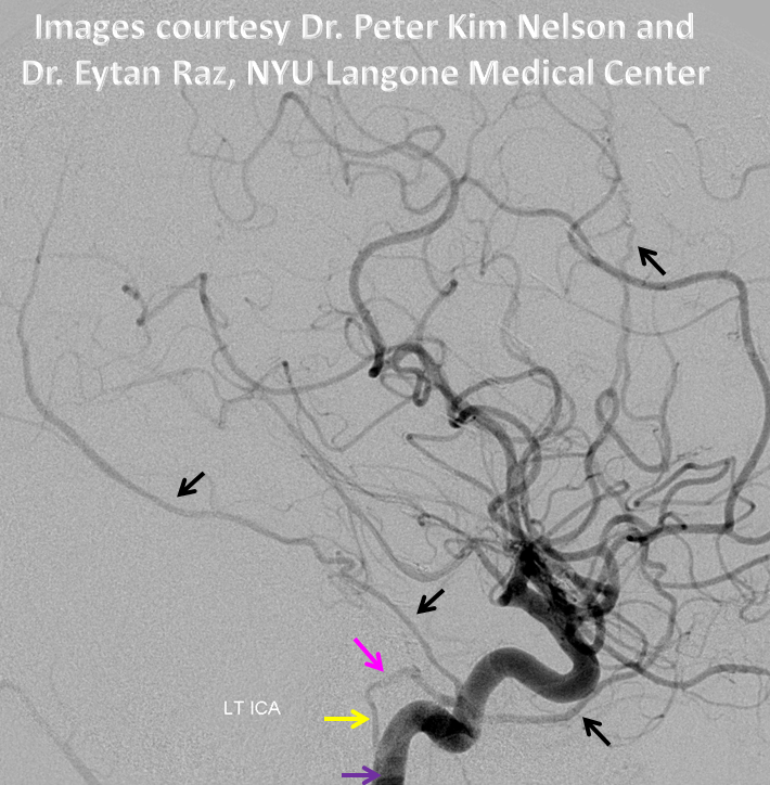 http://www.neuroangio.org/wp-content/uploads/Stapedial_Artery/Stapedial_Artery_2.png