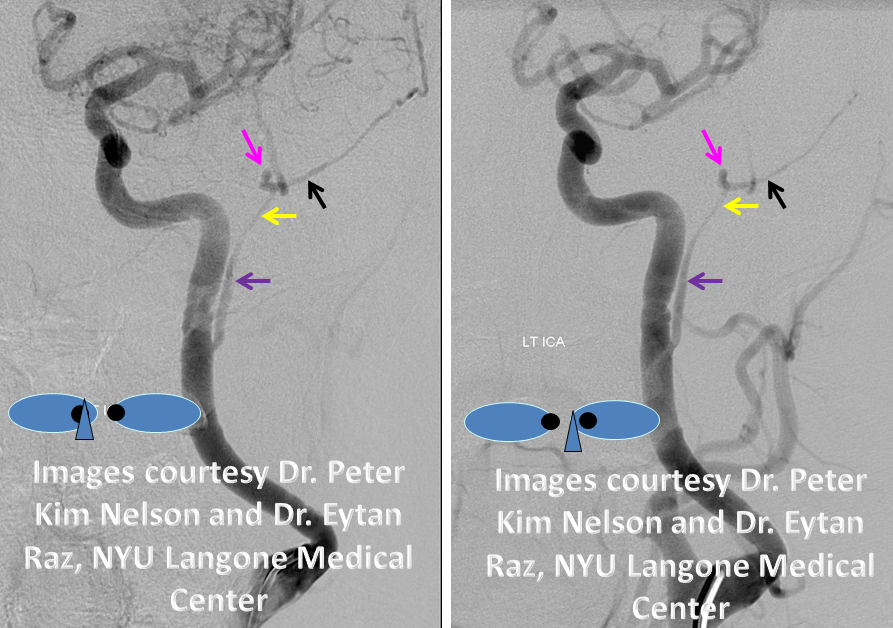 http://www.neuroangio.org/wp-content/uploads/Stapedial_Artery/Stapedial_Artery_3.png