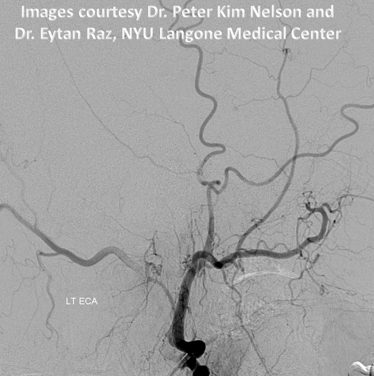 http://www.neuroangio.org/wp-content/uploads/Stapedial_Artery/Stapedial_Artery_6.png