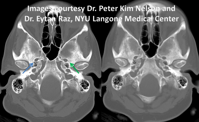 http://www.neuroangio.org/wp-content/uploads/Stapedial_Artery/Stapedial_Artery_7.png