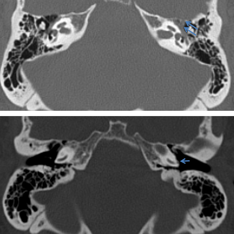 http://www.neuroangio.org/wp-content/uploads/Stapedial_Artery/Stapedial_Artery_9.png