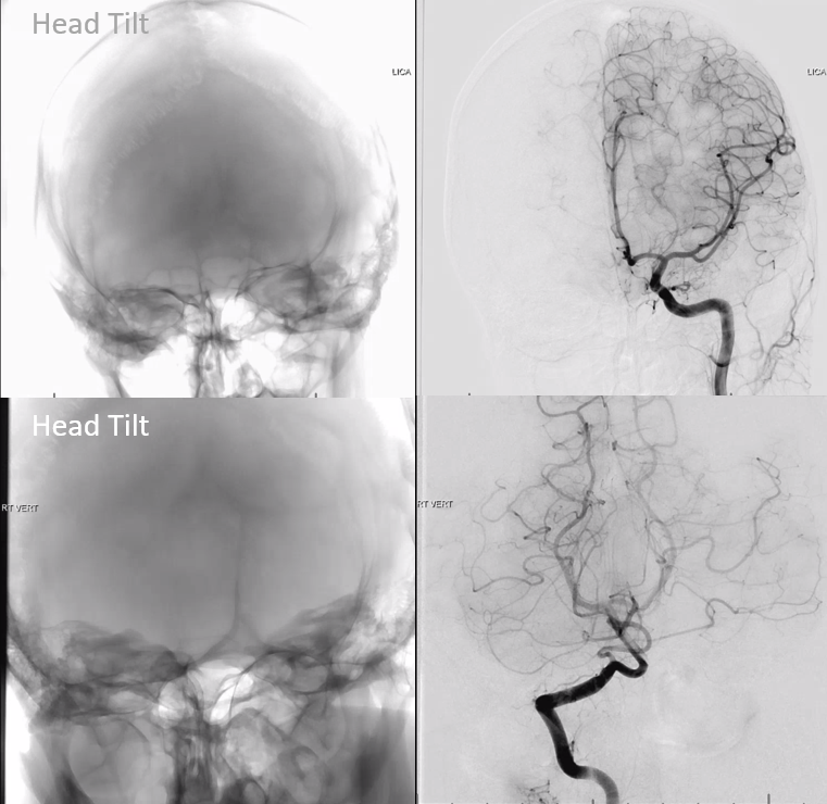 The Art Of Cerebral Angiography