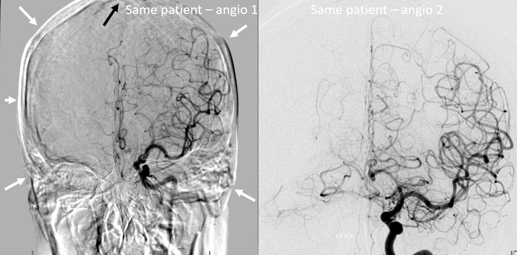 Spinal Vascular Anatomy Neuroangio Org