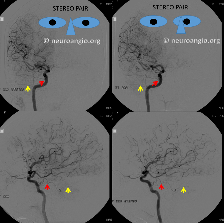 http://www.neuroangio.org/wp-content/uploads/Trigeminal/Trigeminal_Artery_AICA_stereo.png