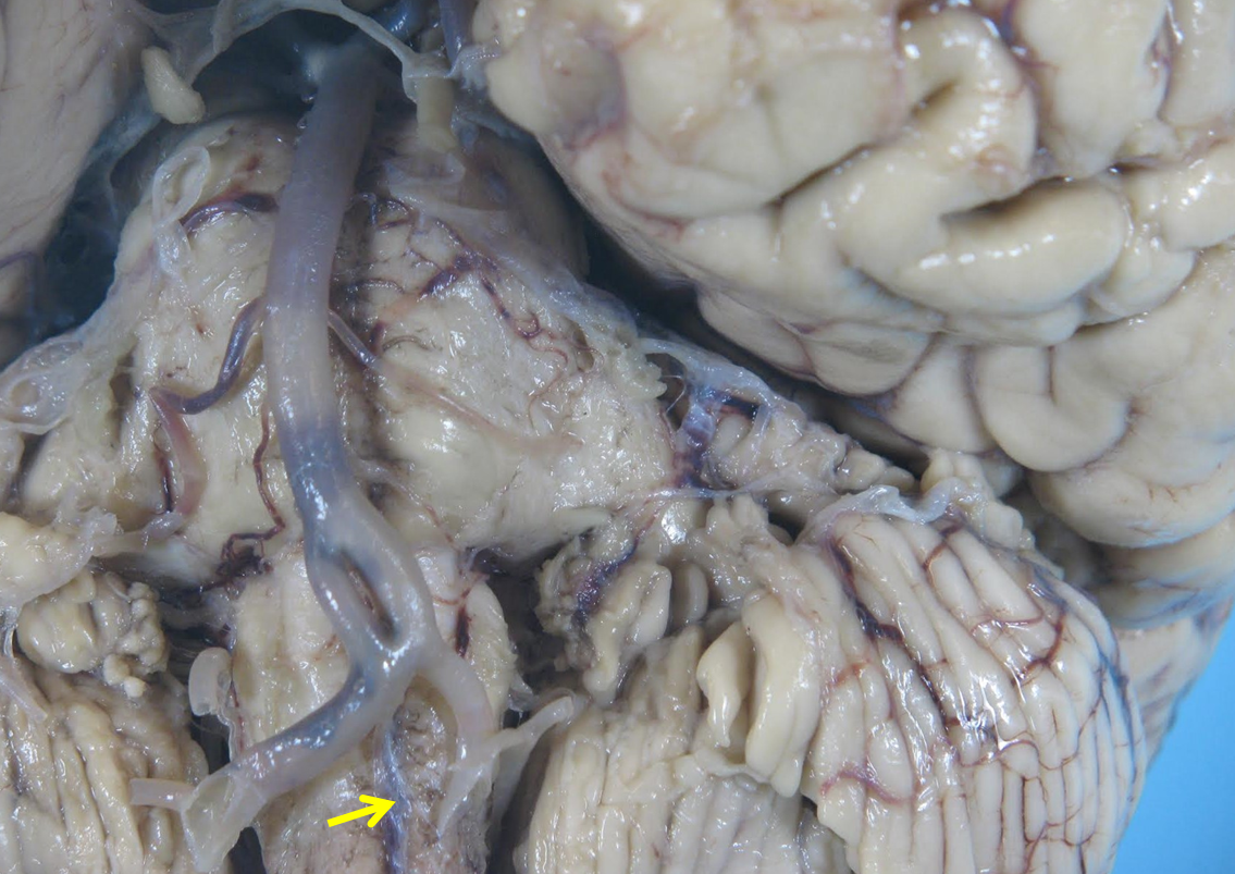 basilar fenestration gross pathology basilar fenestration path