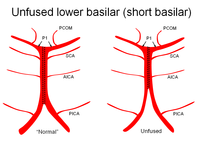 pica syndrome mnemonic