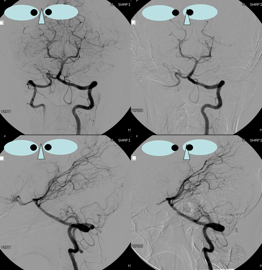 PICA cervical extension