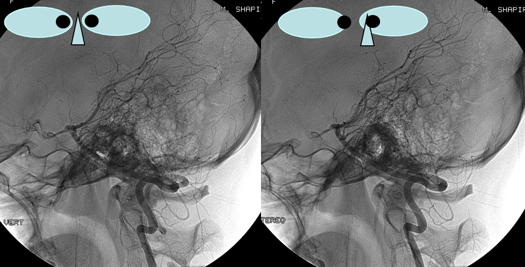 PICA cervical extension native