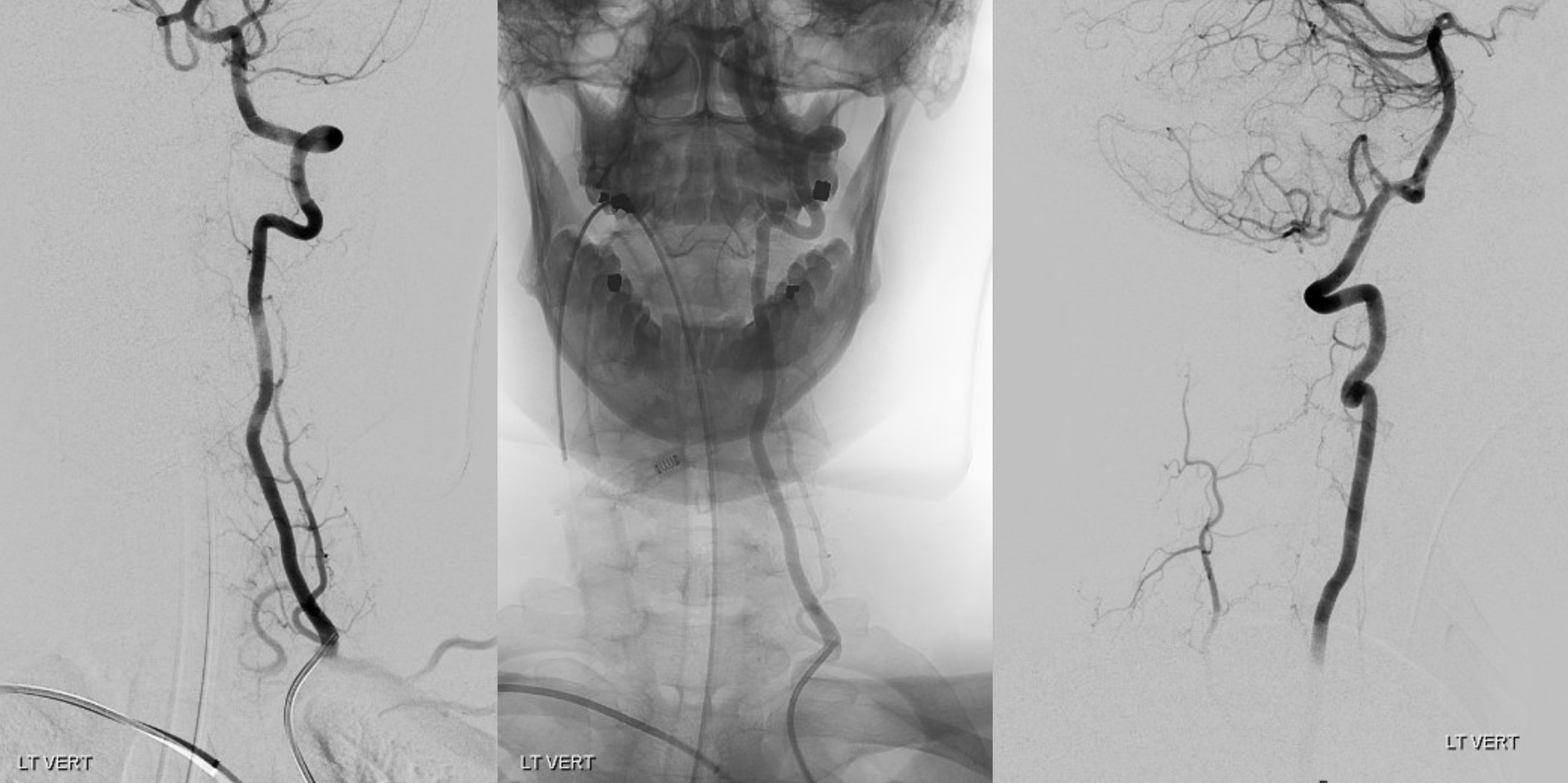 vertebral artery