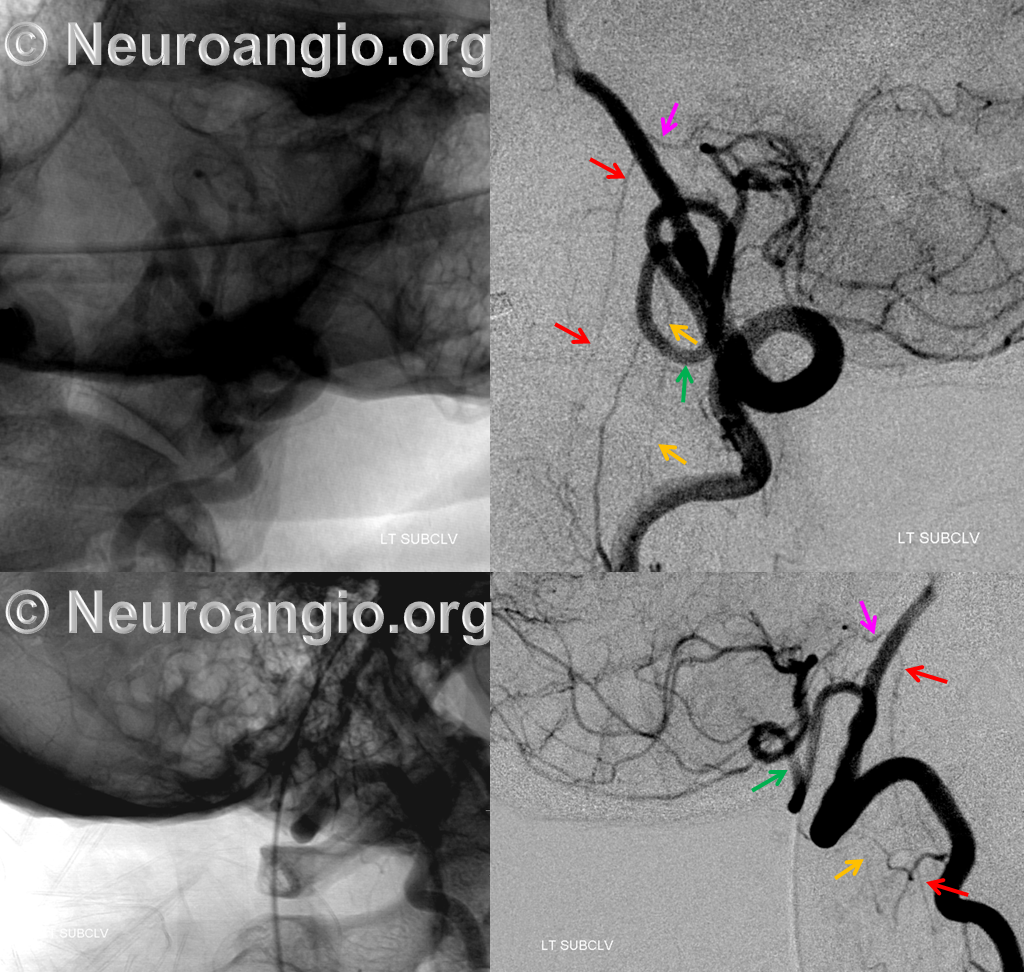 http://www.neuroangio.org/wp-content/uploads/VB/Vert_PICA_C1_lateral_anterior_spinal.png