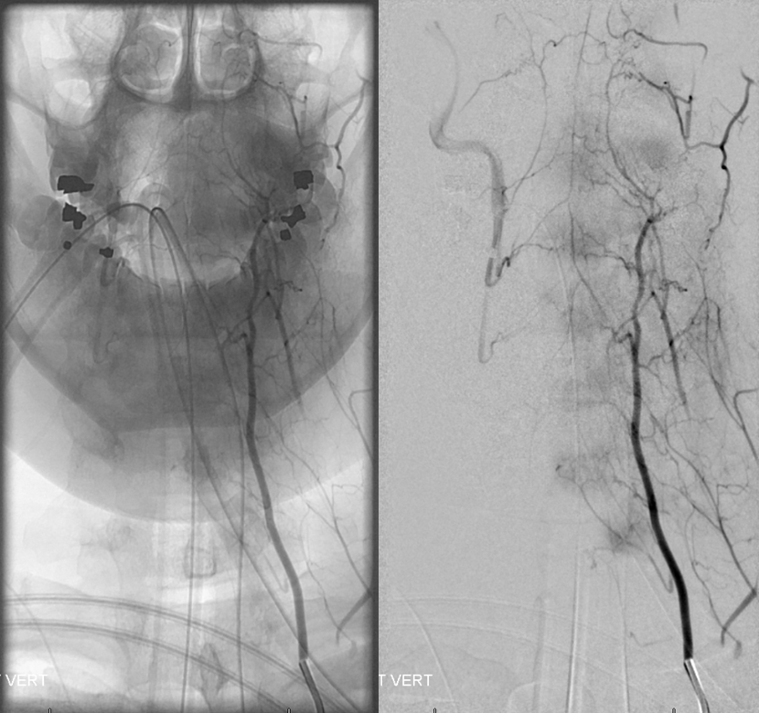 vertebral artery anastomoses