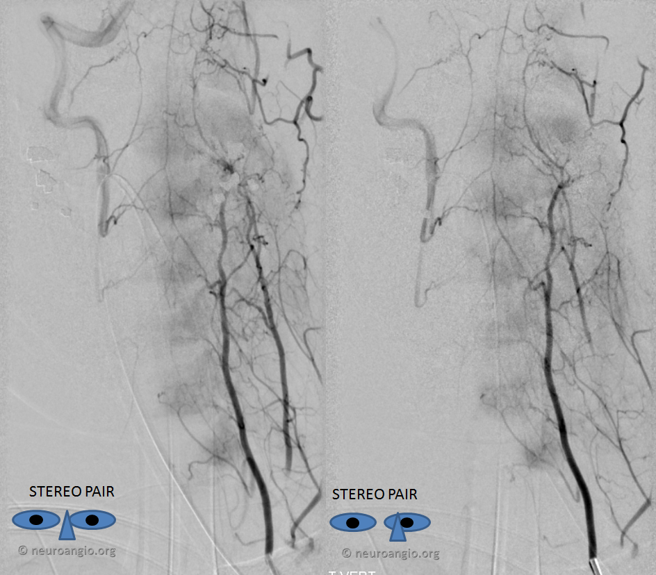 vertebral artery anastomoses