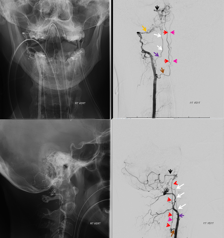 vert dissection duplicated anterior spinal artery