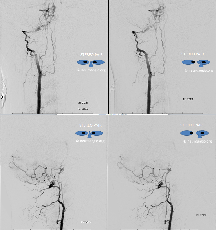 vert dissection duplicated anterior spinal artery