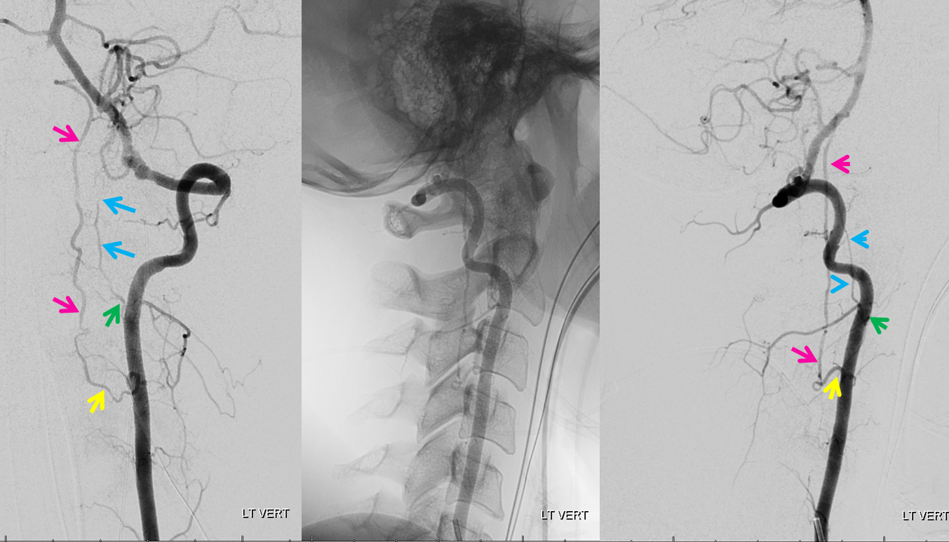 anterior spinal artery duplication