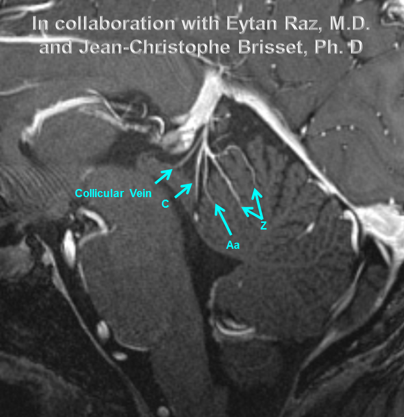 http://www.neuroangio.org/wp-content/uploads/Venous/Posterior_Fossa_Veins/V_7T_MRI_culmen_collicular_veins.png