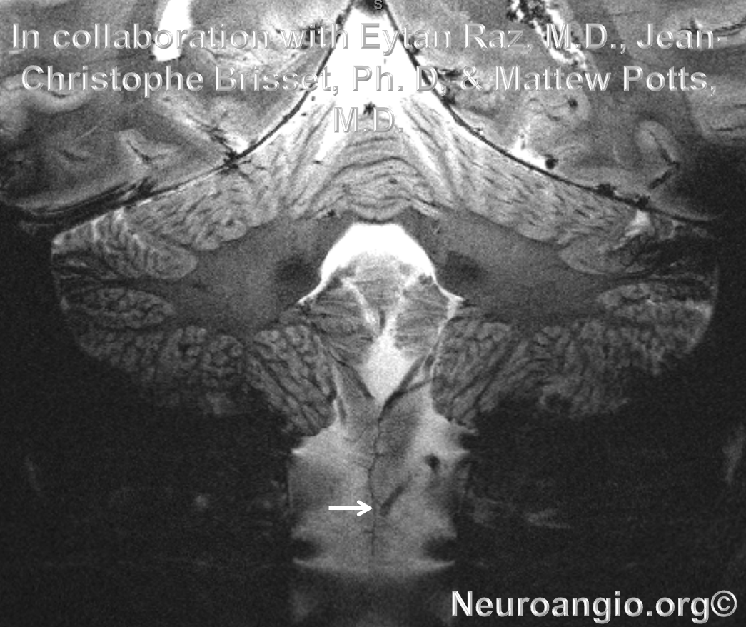 http://www.neuroangio.org/wp-content/uploads/Venous/Posterior_Fossa_Veins/V_7T_MRI_posterior_spinal_vein.png