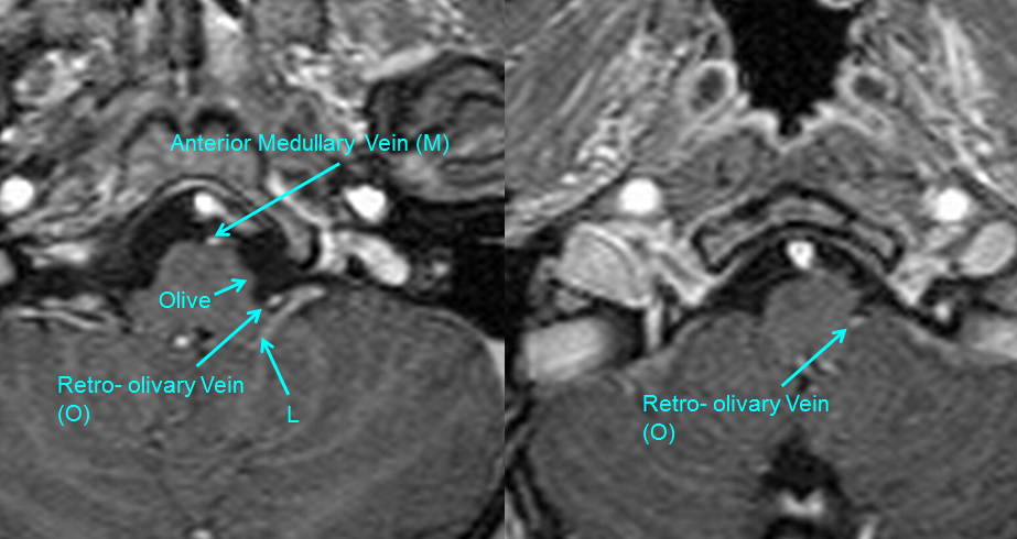 http://www.neuroangio.org/wp-content/uploads/Venous/Posterior_Fossa_Veins/V_anterior_medullary_retro_olivary_veins_MRI.png