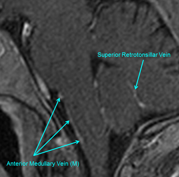 http://www.neuroangio.org/wp-content/uploads/Venous/Posterior_Fossa_Veins/V_anterior_medullary_vein_MRI.png