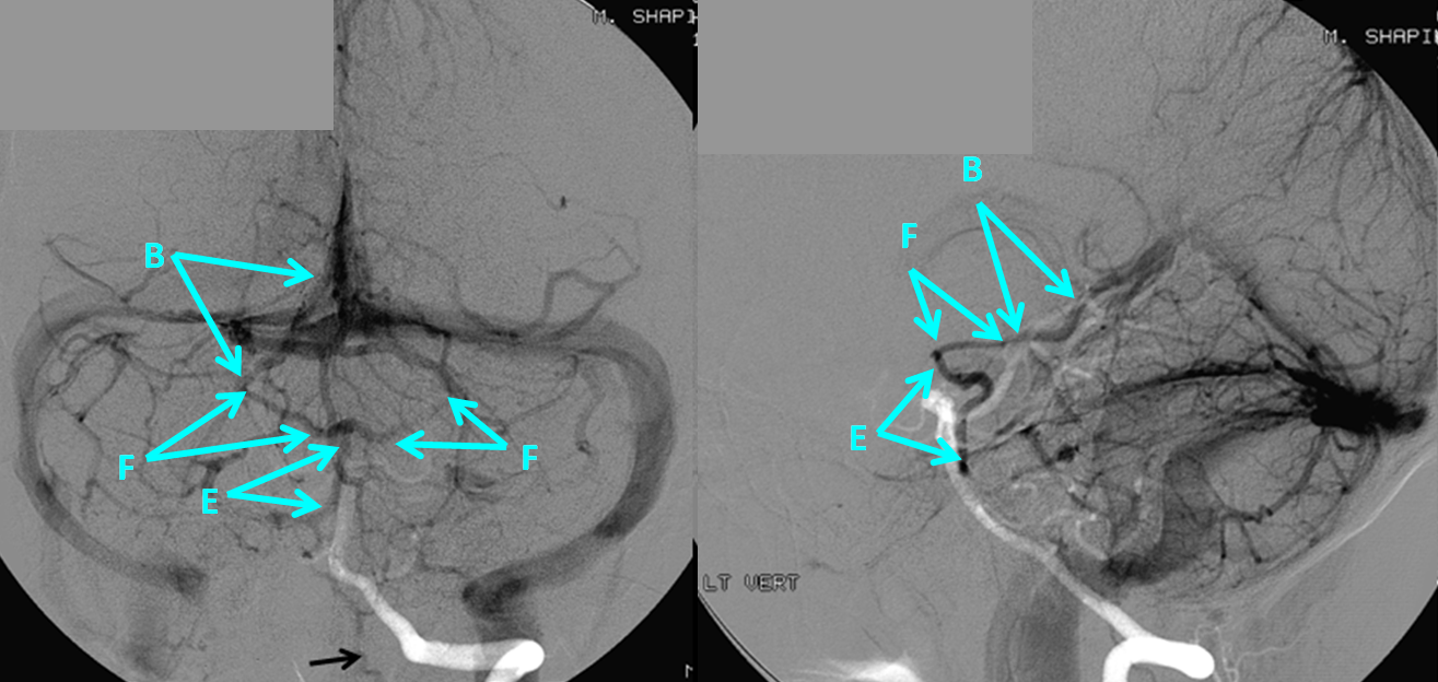 http://www.neuroangio.org/wp-content/uploads/Venous/Posterior_Fossa_Veins/V_anterior_mesencephalic_dominance.PNG