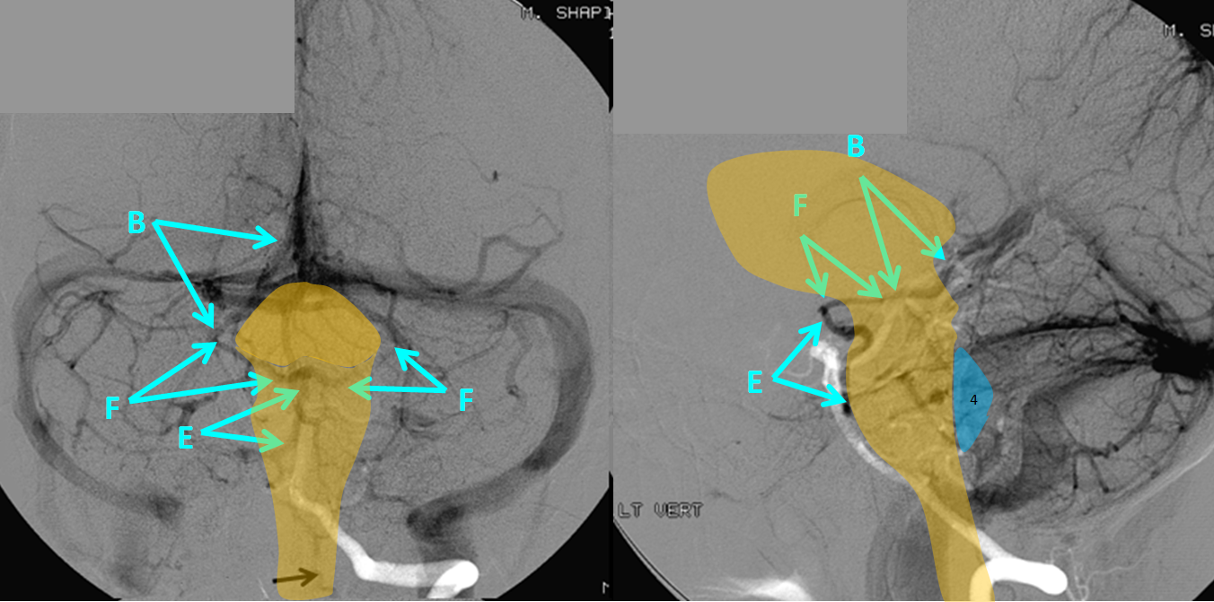 http://www.neuroangio.org/wp-content/uploads/Venous/Posterior_Fossa_Veins/V_anterior_mesencephalic_dominance_brainstem_overlay.PNG